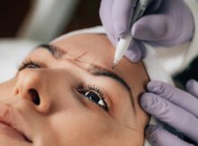 Brow lift